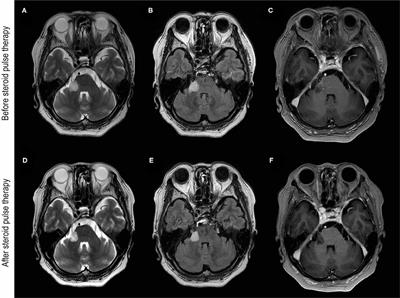 MOG Antibody-Associated Disorders Following SARS-CoV-2 Vaccination: A Case Report and Literature Review